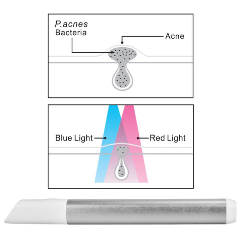 Light Therapy Acne Spot Treatment