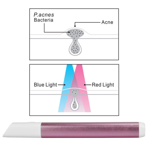 Light Therapy Acne Spot Treatment